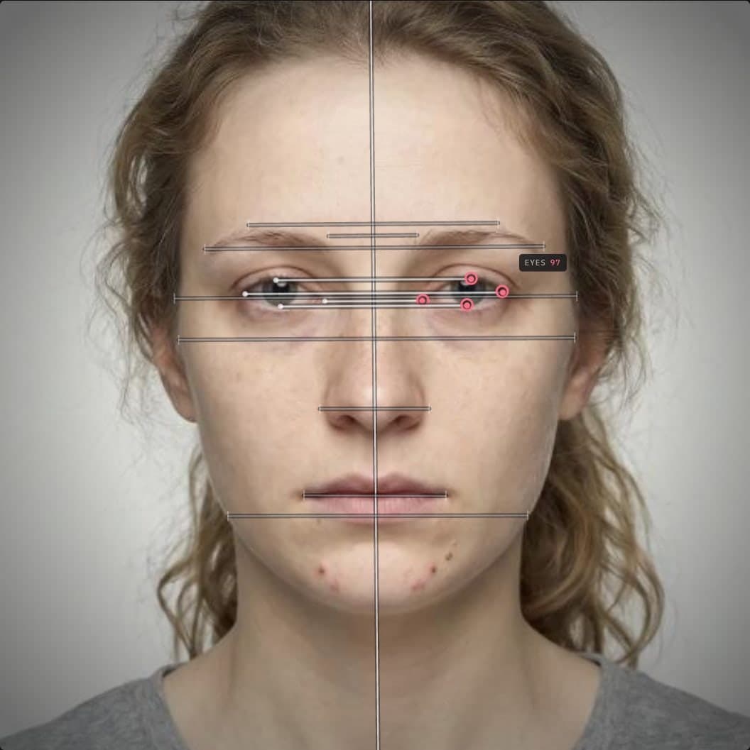 Facial symmetry exercises baseline example: a straight-on photo with the midline axis fitted and each left-right landmark pair joined by a horizontal bar, eye region scoring 97